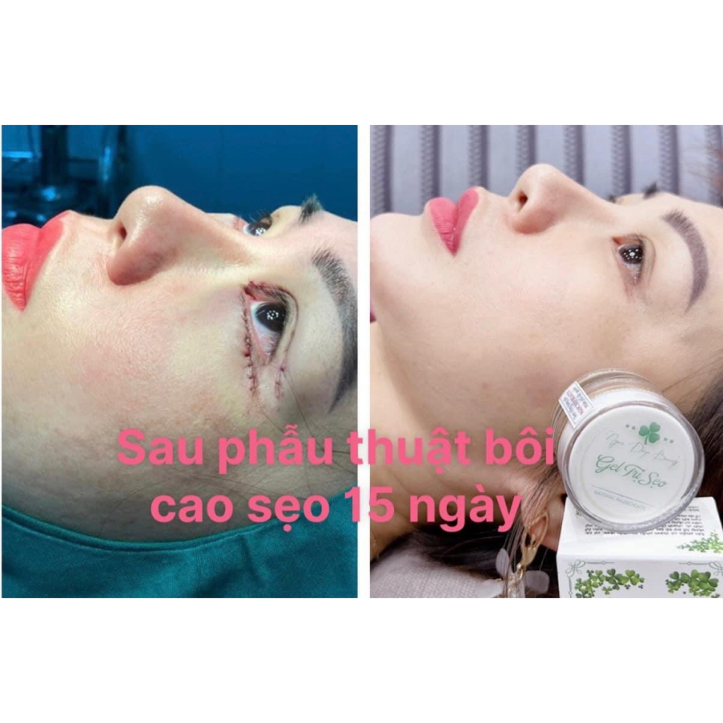 Gen Sẹo Colagen  . Gel Sẹo Rỗ , Sẹo Lõm