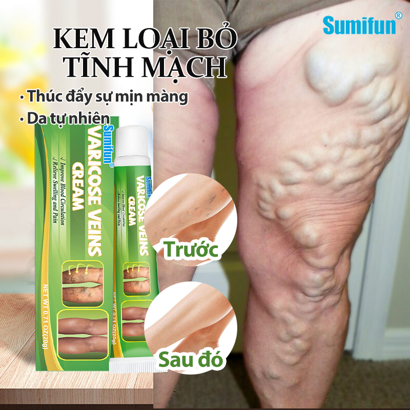 【Giảm đau và khôi phục tĩnh mạch】SUMIFUN Kem giãn tĩnh mạch Suy giãn tĩnh mạch Loại bỏ tĩnh mạch Chống giãn tĩnh mạch