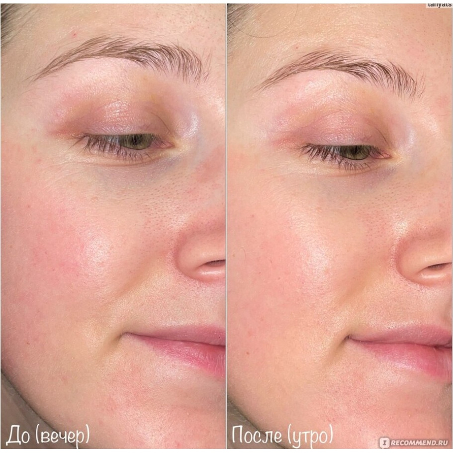 Tinh Chất Tẩy Tế Bào Chết Care:nel AHA 30% BHA 2% Peeling Serum 30ml