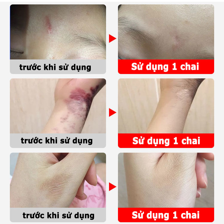 Hiệu quả nhanh chóng kem trị sẹo thâm/trị rạn da sau sinh/sẹo rỗ/trị sẹo lồi thuốc trị sẹo bỏng