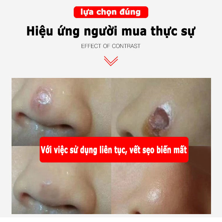 Hiệu quả nhanh chóng kem trị sẹo thâm/trị rạn da sau sinh/sẹo rỗ/trị sẹo lồi thuốc trị sẹo bỏng