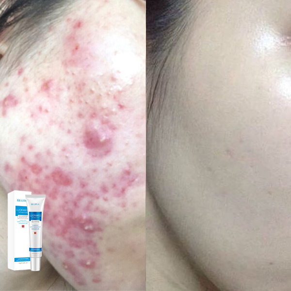 Kem thâm mụn Đánh Bay Mụn làm mặt nạ giảm mụn kem thâm mụn mụn tàn nhang làm trắng dưỡng ẩm 30g