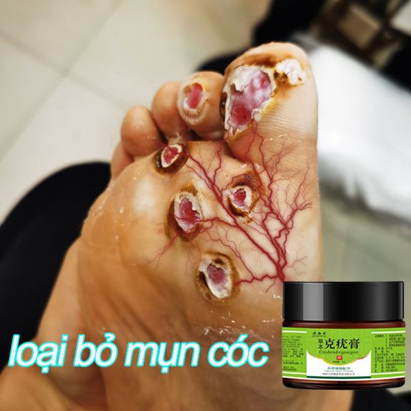 Kem tẩy mụn cóc Tẩy nốt ruồi miếng dán mụn cóc mụn thịt sẹo lồi sâu oại bỏ an toàn và không đau mụn cóc ở da