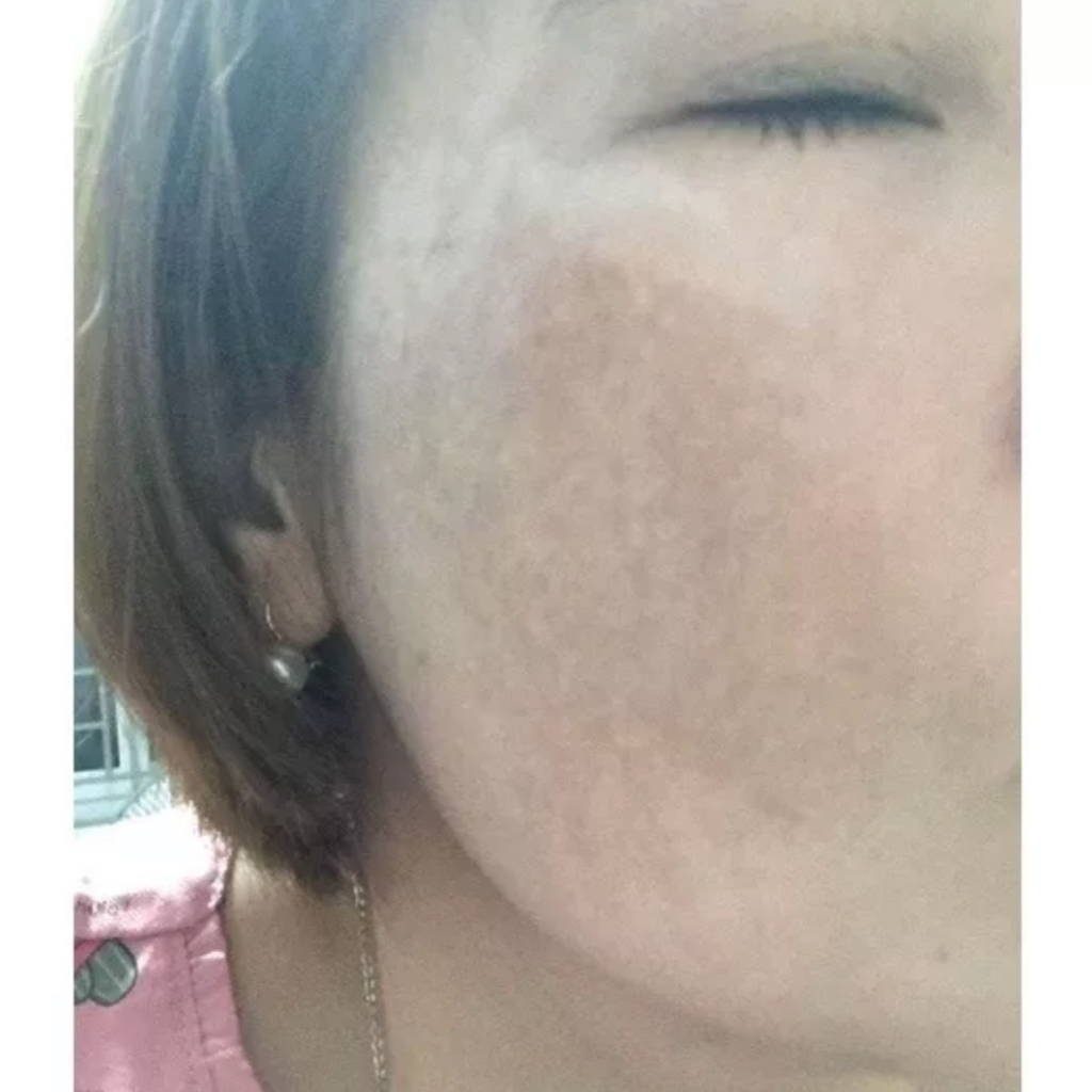 Vua nám skin baby 3 loai 1 MH spa