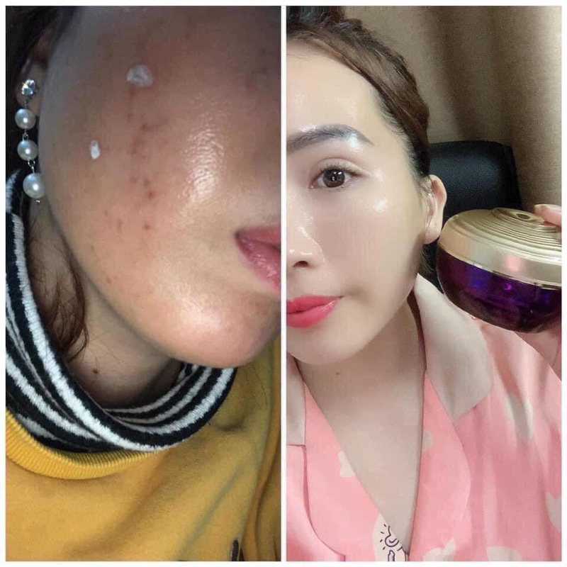 KEM NỌC RẮN HONGIKSKIN STEM 107