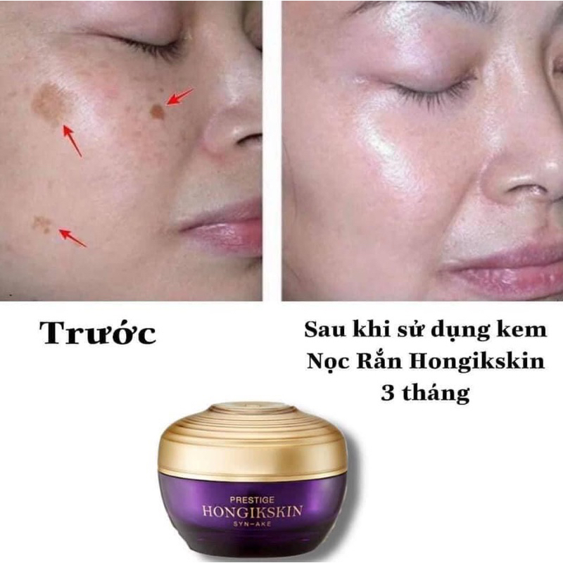 KEM NỌC RẮN HONGIKSKIN STEM 107