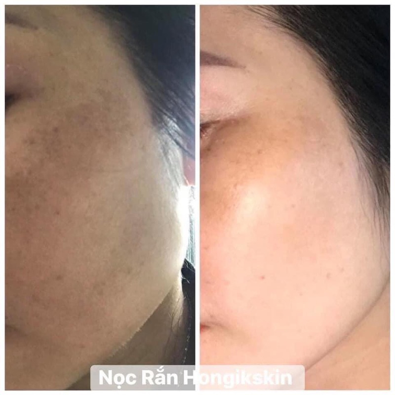 KEM NỌC RẮN HONGIKSKIN STEM 107