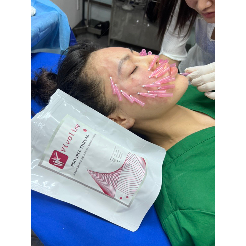 chỉ screw collagen ( 10 sợi)