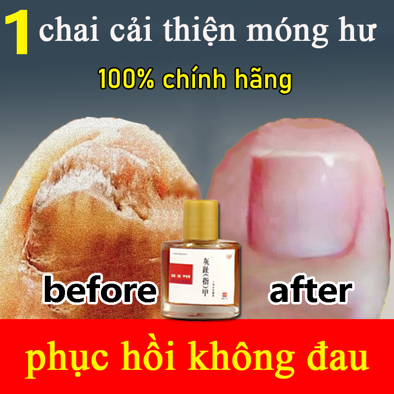 Serum trị nấm móng dưỡng phục hồi móng cải thiện hư tổn móng kích thích mọc móng nhanh chóng nấm móng tay chân