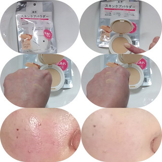 Phấn Phủ Chống Nắng Acmedica Medicated