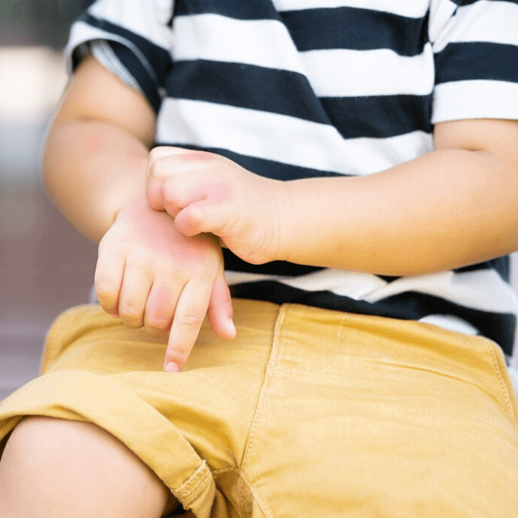 Kem Mopiko Bôi Ngoài Da Ngăn Muỗi Đốt, Côn Trùng Cắn, Giảm Ngứa, Ngừa Sẹo 20g