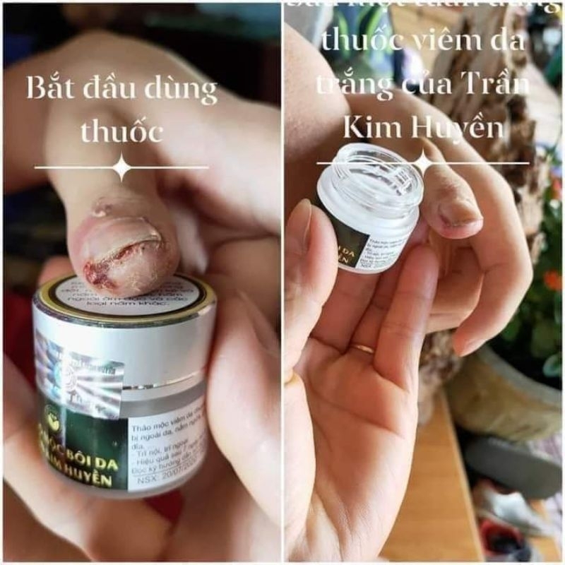 KEM BÔI DA TRẦN KIM HUYỀN CHỐNG NẤM VIÊM