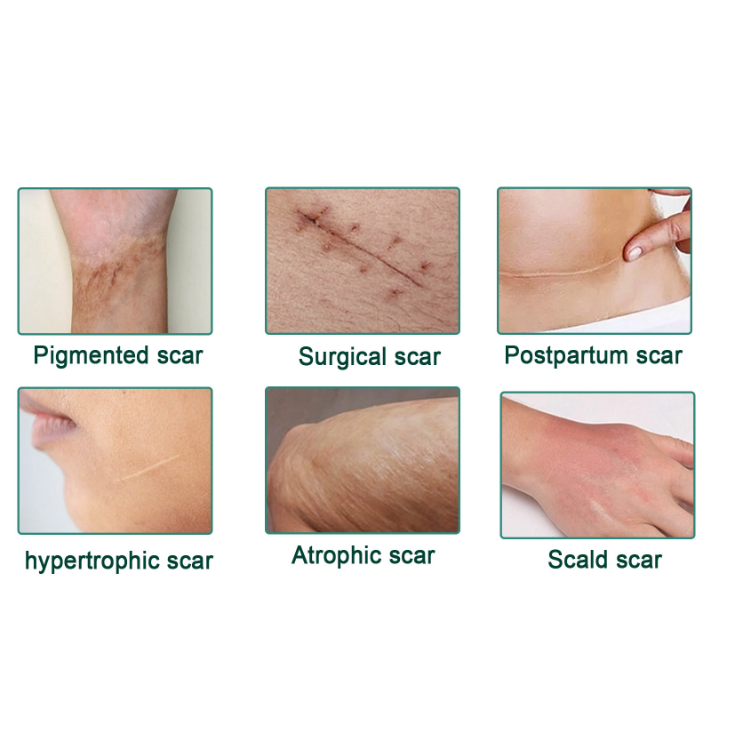 Serum Sẹo Lồi Lõm- Sẹo Rỗ Lâu Năm Blurred Scar