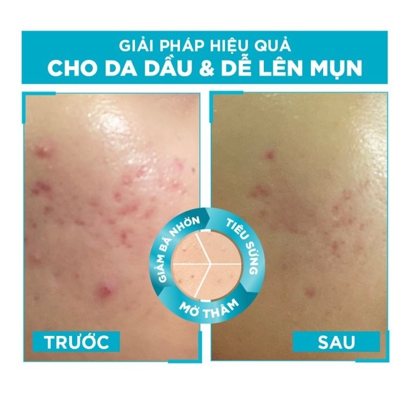 Dưỡng chất cho da dầu mụn, giảm mụn và mờ thâm Bright Complete Anti-Acnes Booster Serum Garnier 7.5ml