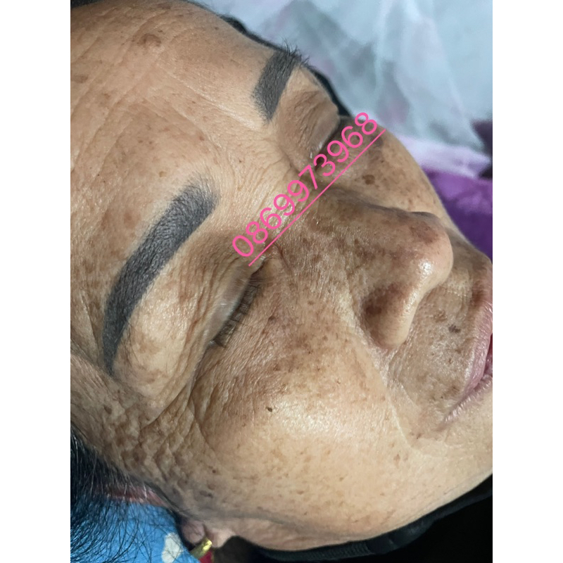 BỘ NÁM TÀN NHANG , MỤN LCL THÂM MẮT ,CHÂN SÂU DA NHIỀU NẾP NHĂN LÃO HOÁ DA BỊ  COD