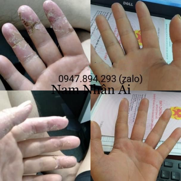 Tổ đỉa - Chàm - Chàm sữa - Mẩn Ngứa - Ghẻ nước đông y ông Lam