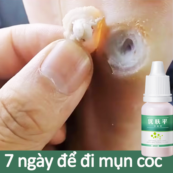 Tẩy nốt ruồi kem tẩy nốt ruồi gel tẩy nốt ruồi 10ML Loại bỏ mụn cóc và nốt ruồi hiệu quả chính hãng 100%
