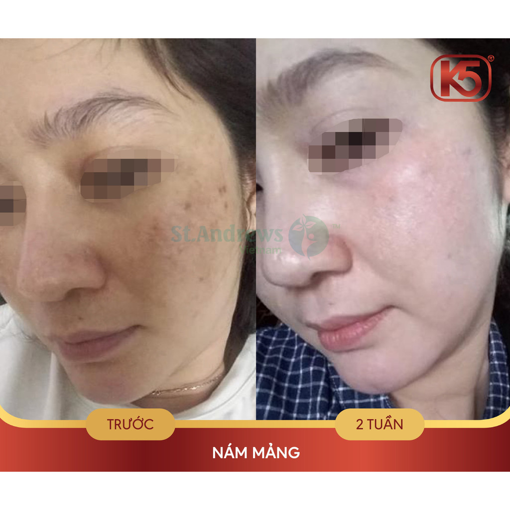 Kem tăng sắc tố sau laser, peel da K5 Cryolaser 20ml - bệnh viện da liễu trung ương tin dùng