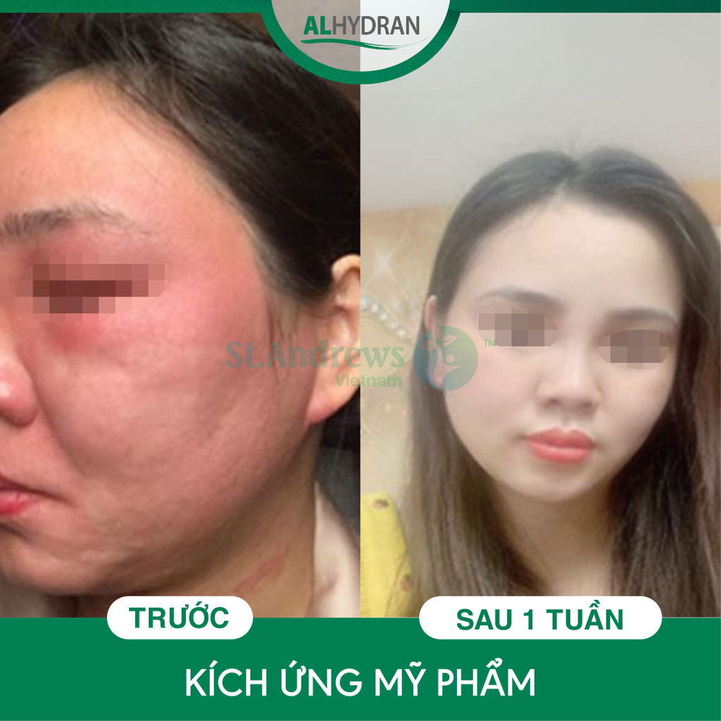 Kem dưỡng làm dịu da sau cháy nắng Alhydran 15ml - phục hồi, dưỡng da sáng đều màu