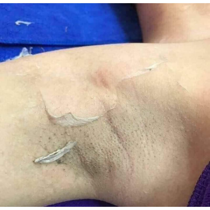 Vi tảo không sưng, không đỏ dùng cho mặt, mụn thâm nách, mông, lưng,body..