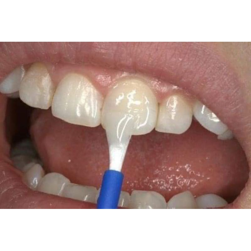 Vecni fluor chống sâu răng, hà mủn, trắng răng, ăn toàn cho trẻ từ 1 tuổi.