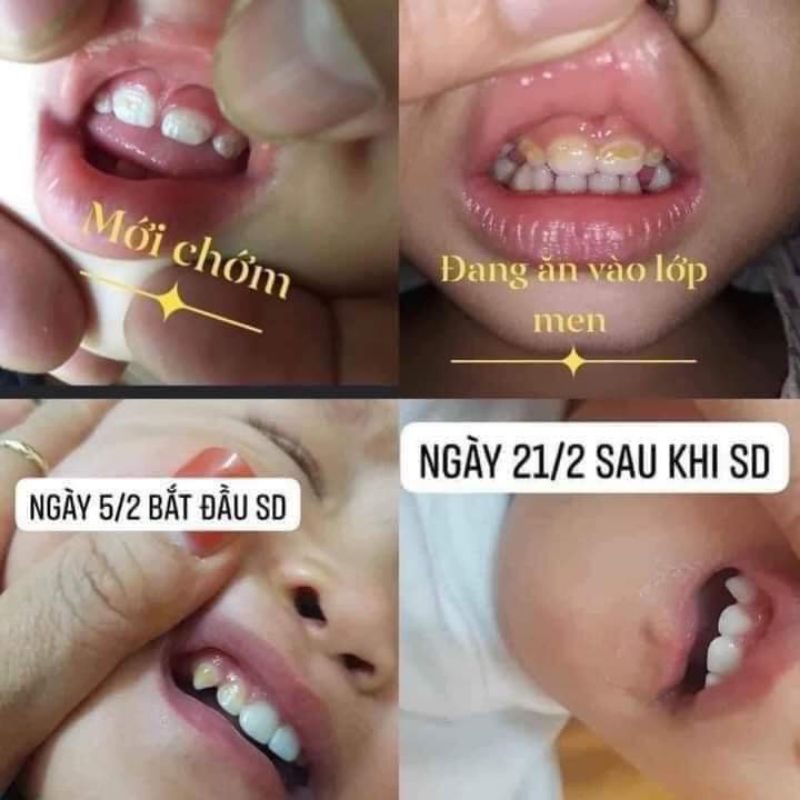 Vecni fluor chống sâu răng, hà mủn, trắng răng, ăn toàn cho trẻ từ 1 tuổi.