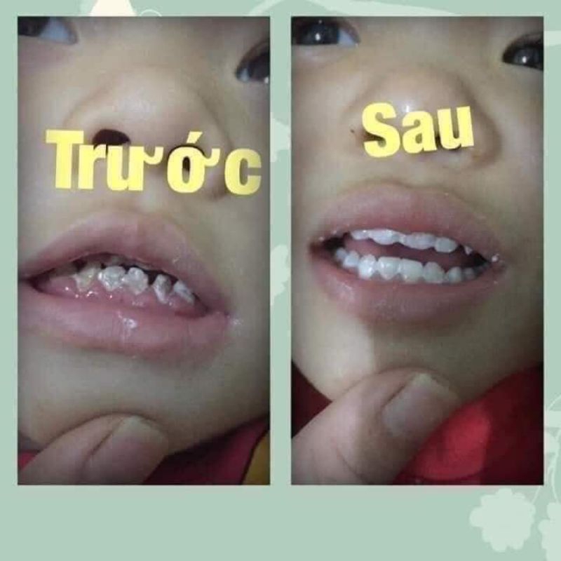 Vecni fluor chống sâu răng, hà mủn, trắng răng, ăn toàn cho trẻ từ 1 tuổi.