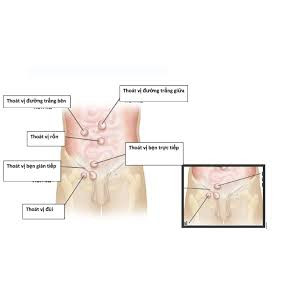 (hỏa tốc) ĐAI THOÁT VỊ BẸN