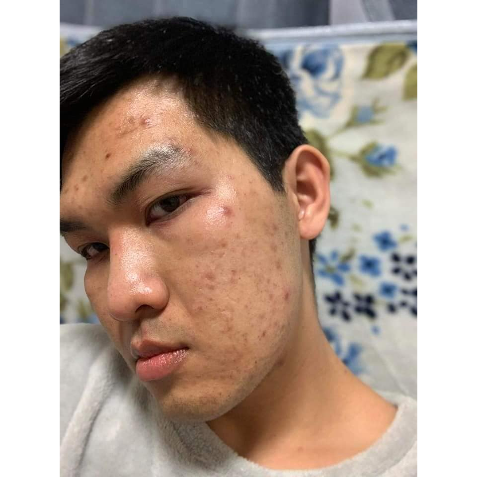 Serum Ngừa Mụn, Dưỡng Ẩm Da ACNE Serum – Adore Skin 10ml