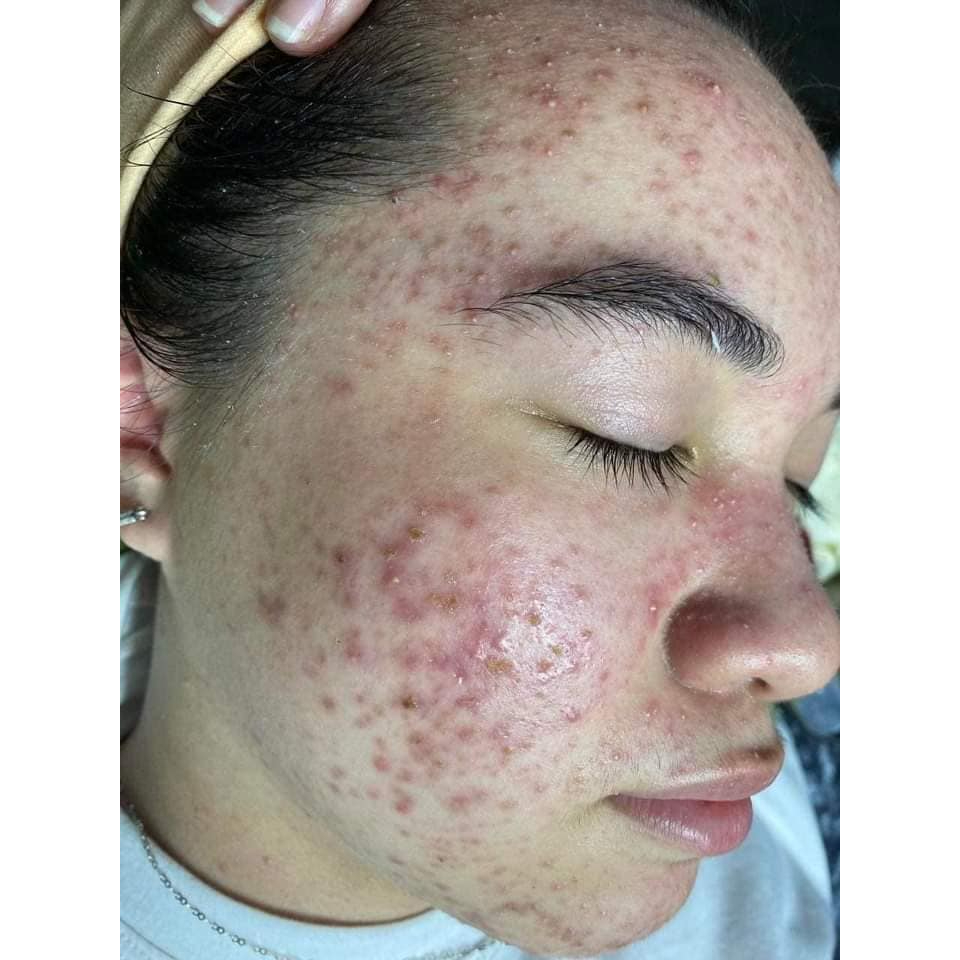 Serum Ngừa Mụn, Dưỡng Ẩm Da ACNE Serum – Adore Skin 10ml