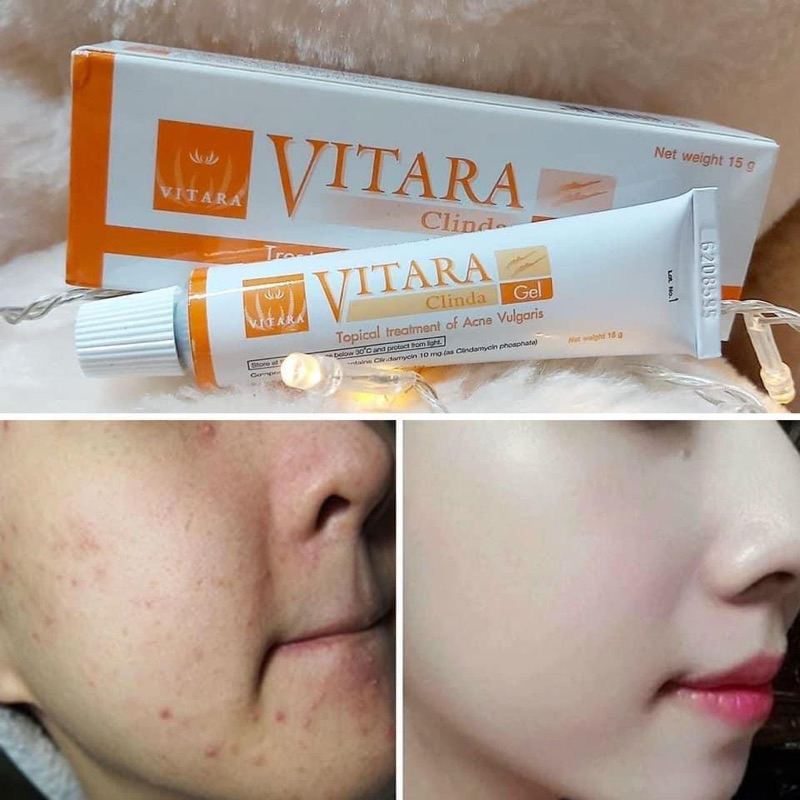 VITARA CLINDA GEL 15g Kem ngừa mụn mủ mụn viên