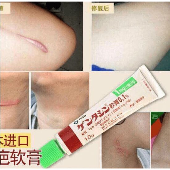 Kem mờ sẹo Gentacin Nhật Bản giảm thâm xoa sẹo hiệu quả 10g