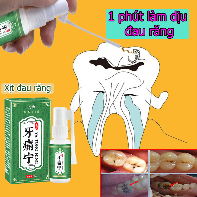 Xịt đau răng Xịt sâu răng Chai Xịt Giảm Đau Răng Giảm Đau Nhức Nhanh Chóng Ngăn Ngừa Sâu Răng Và Làm Thơm Miệng