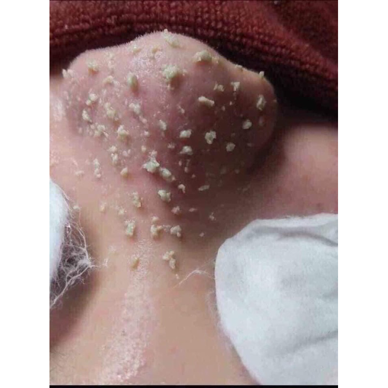 Ủ mụn Youngerc đầu đen, mụn cám Youngerc