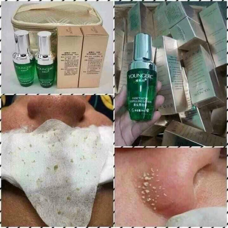 Ủ mụn Youngerc đầu đen, mụn cám Youngerc