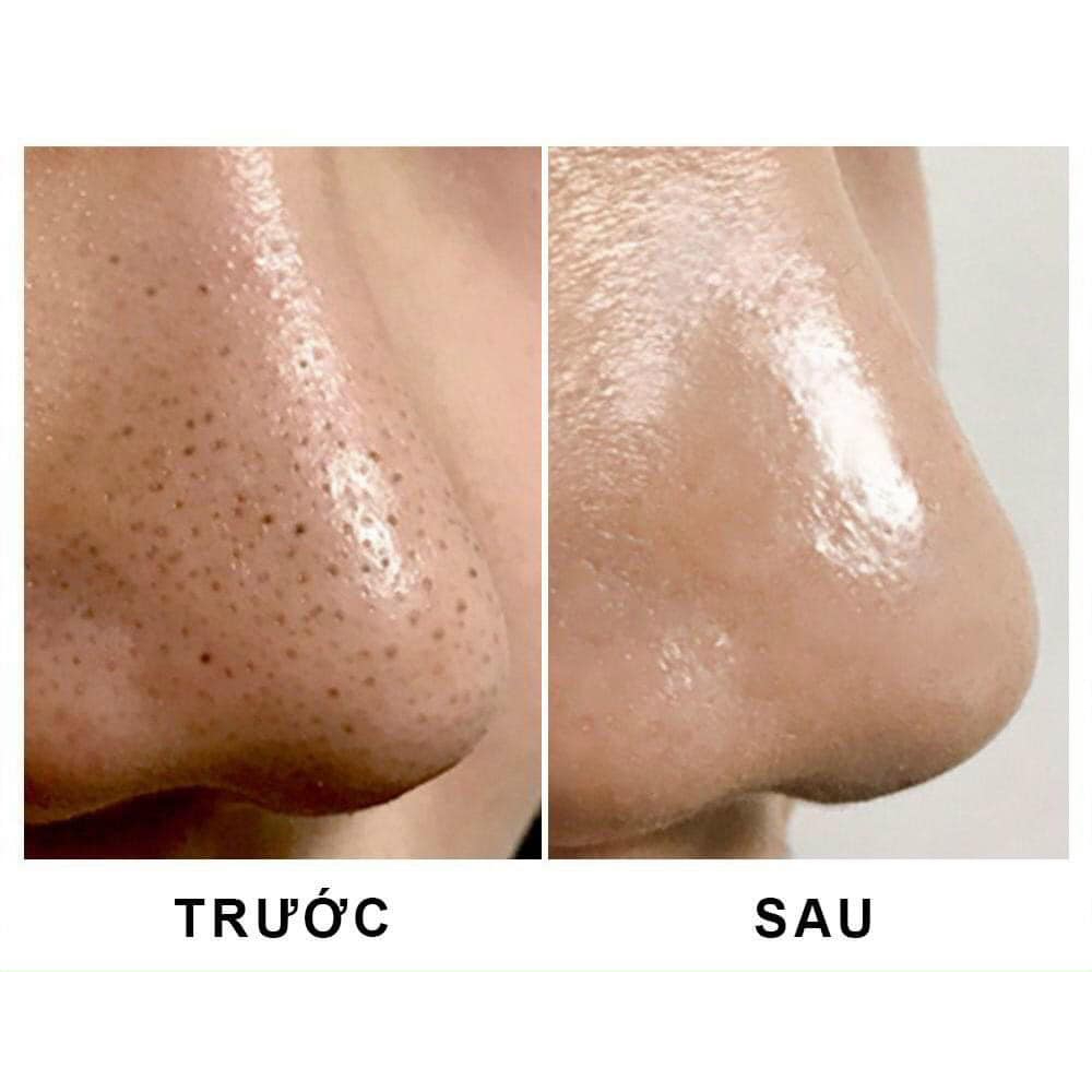 TINH CHẤT ĐẨY MỤN ĐẦU ĐEN ONE-DAY’S YOU PZ SSOC NO MORE BLACKHEAD PORE CLEARING 100ML - 16081