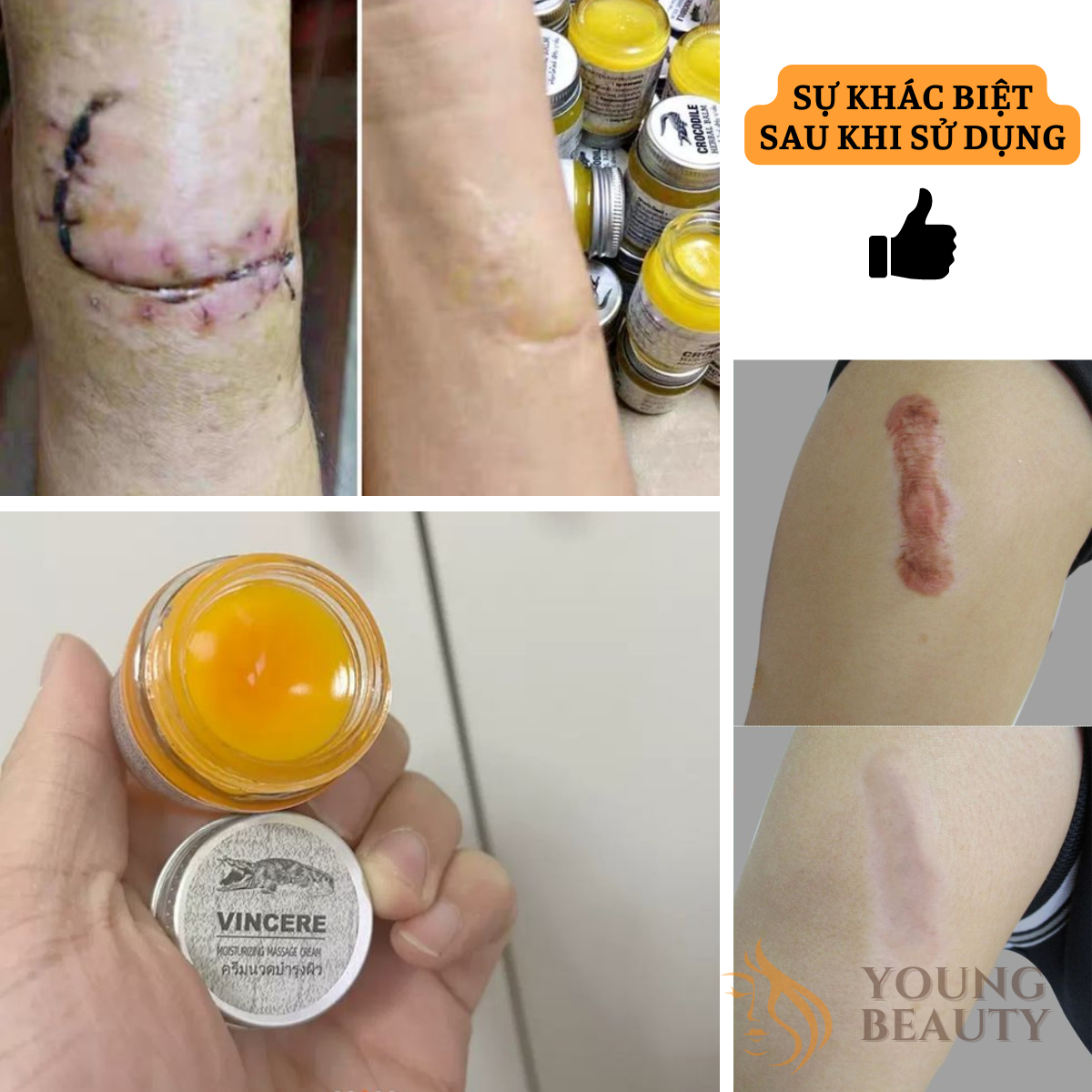 Cao nghệ đỏ lành sẹo VINCERE - Kem mờ sẹo từ mỡ cá sấu giúp lành sẹo lồi, sẹo lõm, sẹo thâm - YOUNG BEAUTY