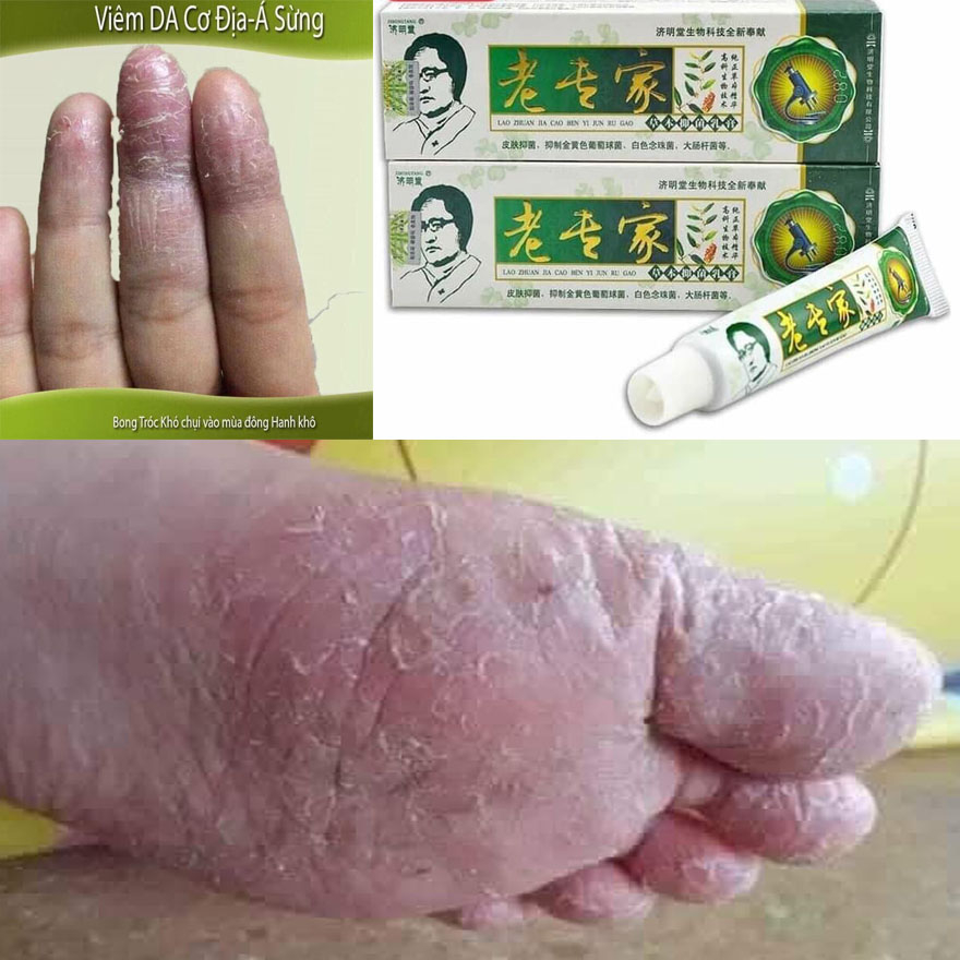 Kem bôi đông y da liễu trung hoa giảm ngứa, chàm, nứt nẻ, vảy nến , á sừng ...