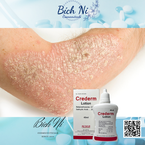 Crederm lotion 40ml dung dịch chăm sóc da Chàm, Vẩy nến, Nấm da đầu