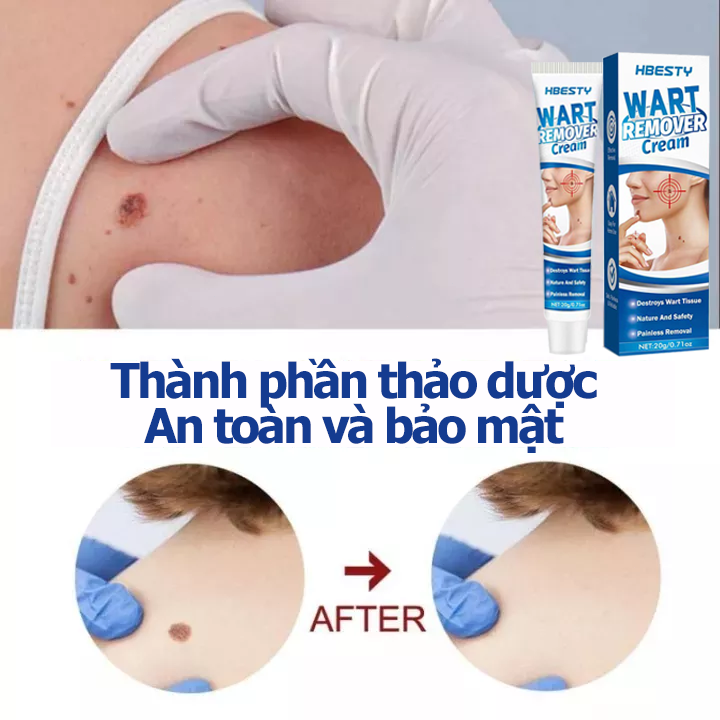 Kem Loại Bỏ Mụn Và Nốt Ruồi 20g xóa nốt ruồi mụn cóc mụn thịt sạch mụn thịt thừa mụn thịt tàn nhang