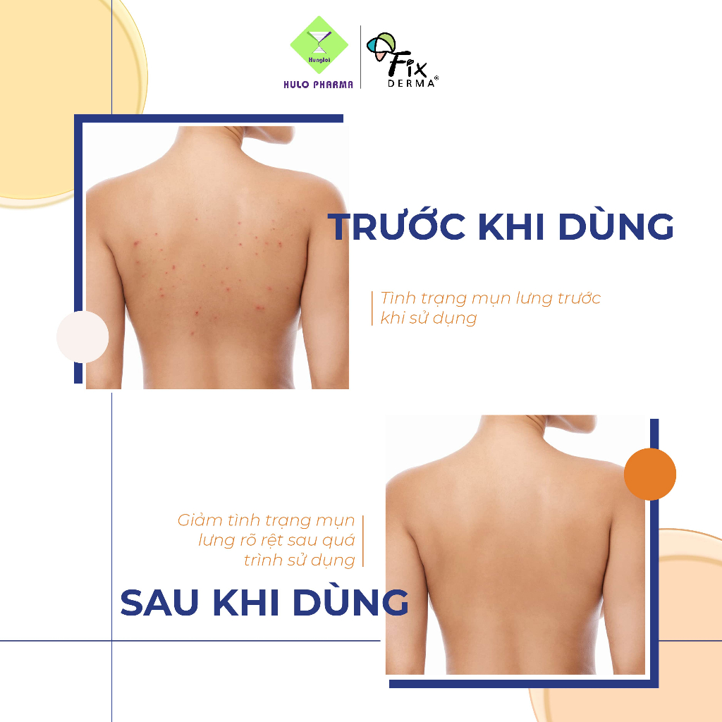 Xịt Mụn Lưng FIXDERMA Salyzap For Body Acne Body Spray Giúp Giảm Mụn, Ngăn Ngừa Mụn Viêm Sưng Ở Cơ Thể 50ml