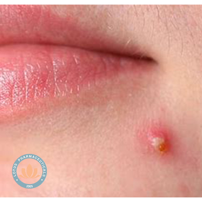 Gel bôi da GELACMEIGEL 15g - Mụn viêm, mụn mủ, mụn trứng cá | Lotuspharma