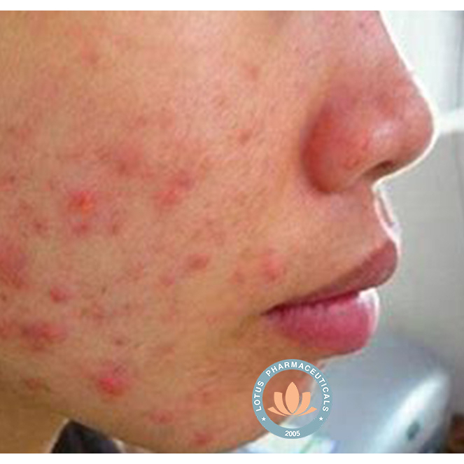 Gel bôi da GELACMEIGEL 15g - Mụn viêm, mụn mủ, mụn trứng cá | Lotuspharma