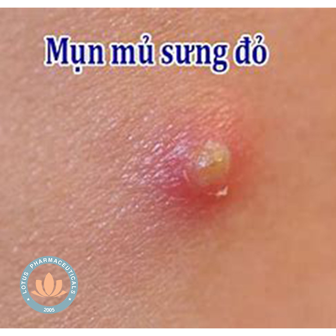 Gel bôi da GELACMEIGEL 15g - Mụn viêm, mụn mủ, mụn trứng cá | Lotuspharma