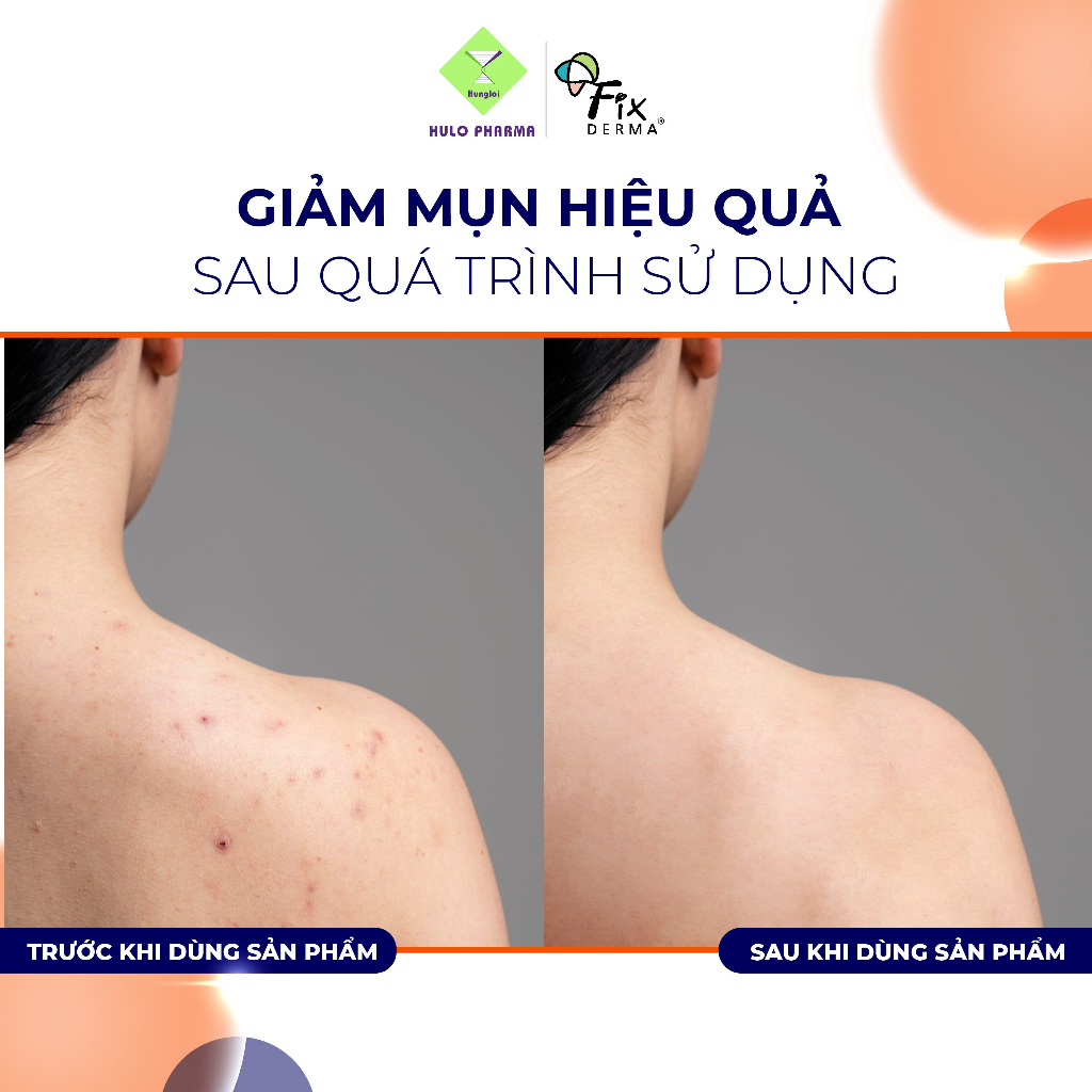 Xà Phòng Giảm Mụn Lưng, Cơ Thể FIXDERMA Salyzap Soap Làm Sạch, Kháng Khuẩn, Trắng Sáng Da 75g