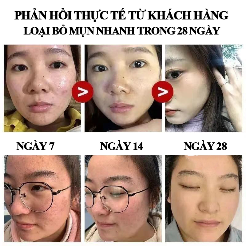 Kem thâm mụn 30g gel ngừa mụn dưỡng ẩm làm sáng da làn da mịn màng dùng cho mụn viêm, mụn bọc, mụn mủ, mụn trứng cá