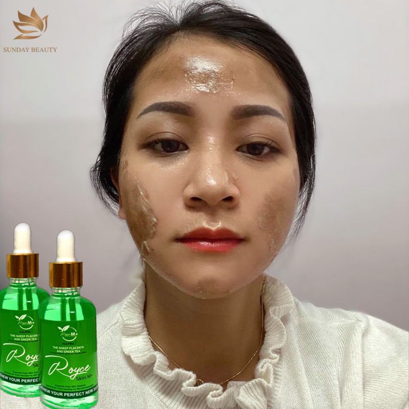 Peel da ROYCE SKIN M+ da bong mảng to bóc tách nám tàn nhang sẹo rỗ mụn thâm