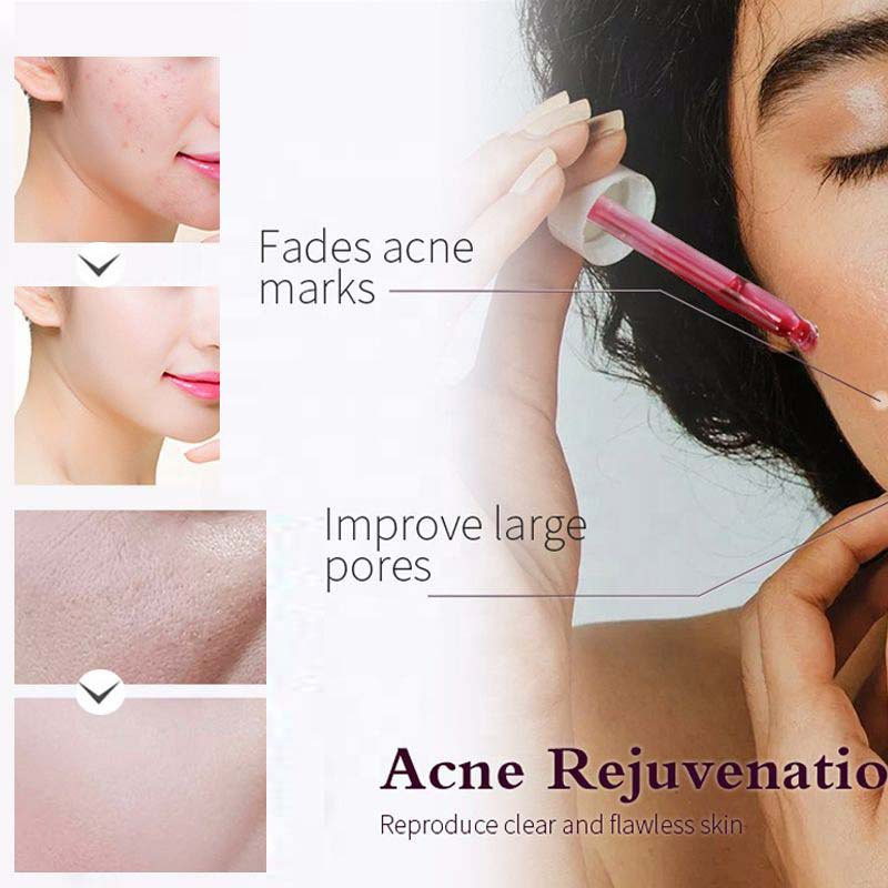 Peel serum tinh chất tái tạo tẩy tế bào chết hoá học KORMESIC