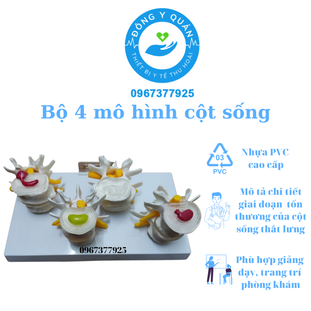 Bộ 4 mô hình PVC mô tả chi tiết tình trạng bệnh lý cột sống thắt lưng và thoát vị đĩa đệm
