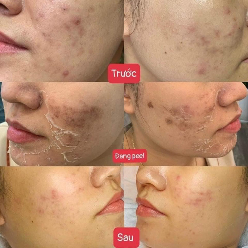 HOẠT CHẤT PEEL DA GIẢM MỤN INNOAESTHETICS SKIN RECOVERY